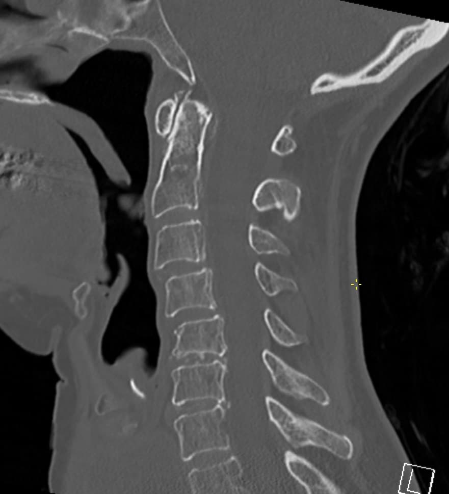 CT-frakturrevision: centrale kontrolpunkter