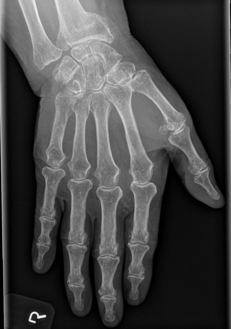 Røde flag i røntgen ved alignment og fraktur-opfølgning